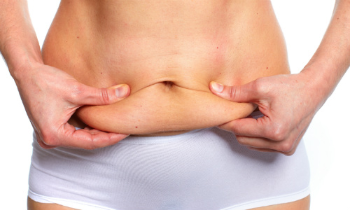 Tummy tuck