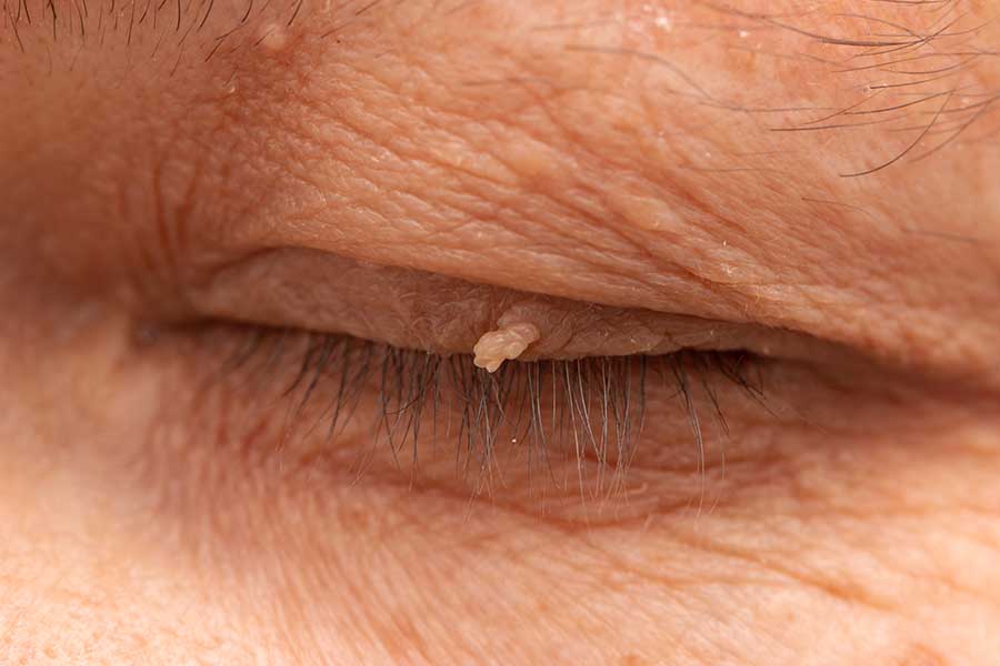 Close-up of a closed eye showing a small, flesh-coloured growth with an irregular surface on the upper eyelid margin, typical of a papilloma.