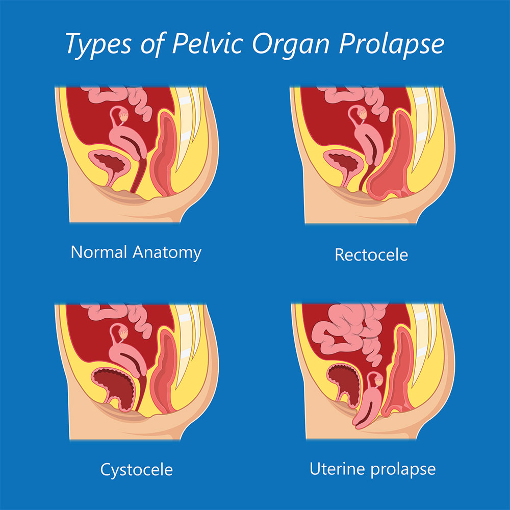 Double Prolapse