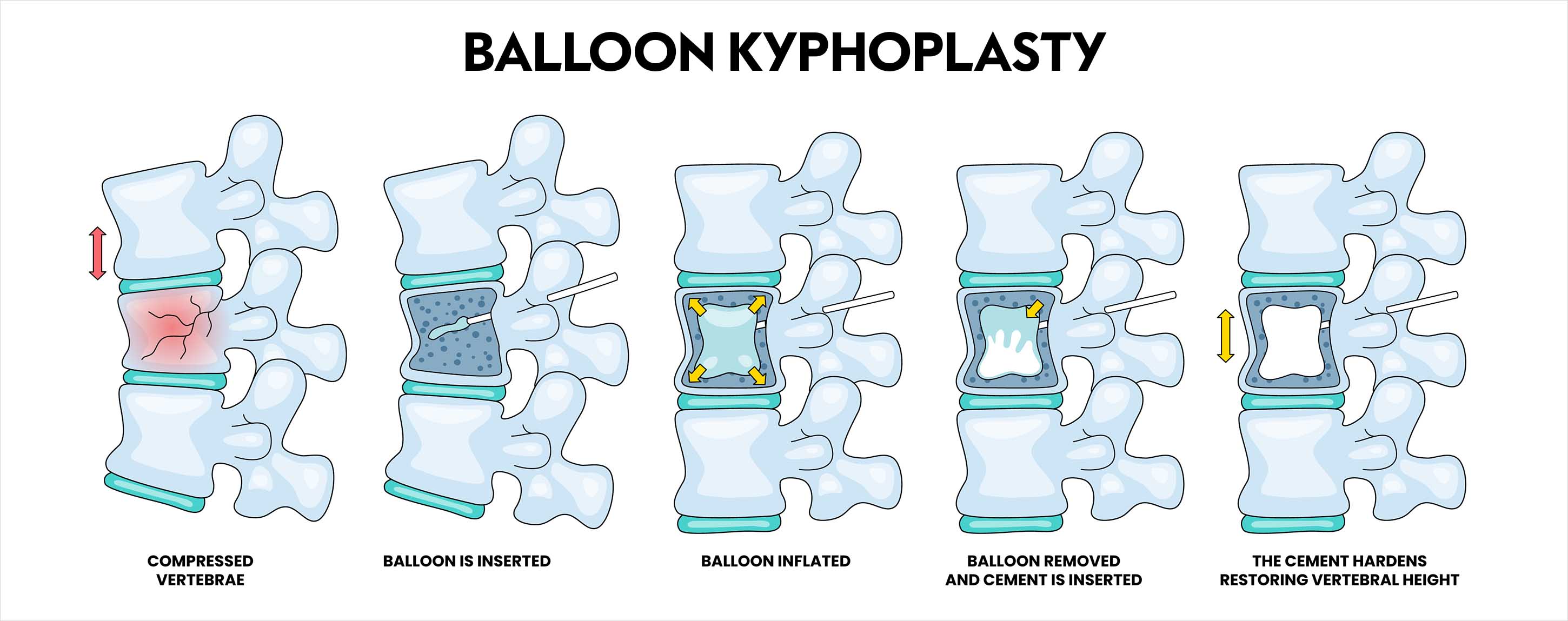 Diagram showing the five stages of balloon kyphoplasty in a spine: a compressed vertebra, a balloon inserted via a needle, the balloon inflated to create space, the balloon removed and cement injected, and the hardened cement restoring vertebral height.