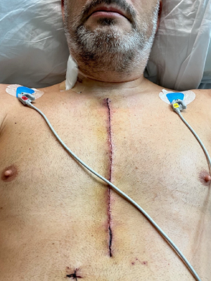 Paul post triple-bypass-heart surgery