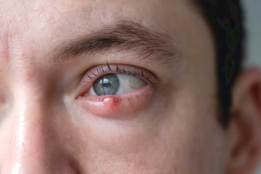 Close-up of an open eye showing a red, swollen lower eyelid with a small yellow-headed lump at the lash line, typical of a stye.