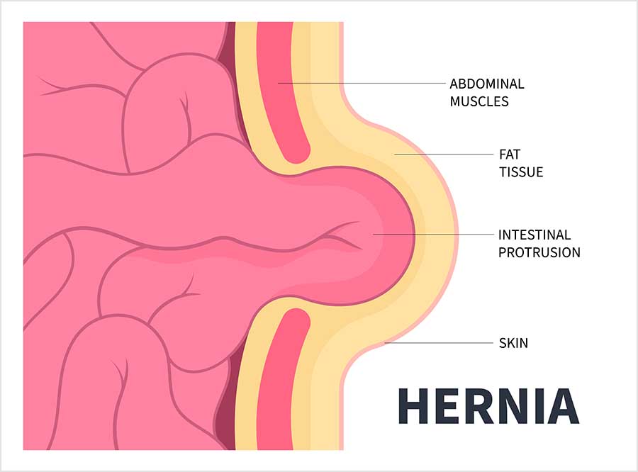 Cross-section illustration of a hernia, with part of the intestine pushing through a gap in the abdominal muscles and bulging out under the fat tissue and skin.