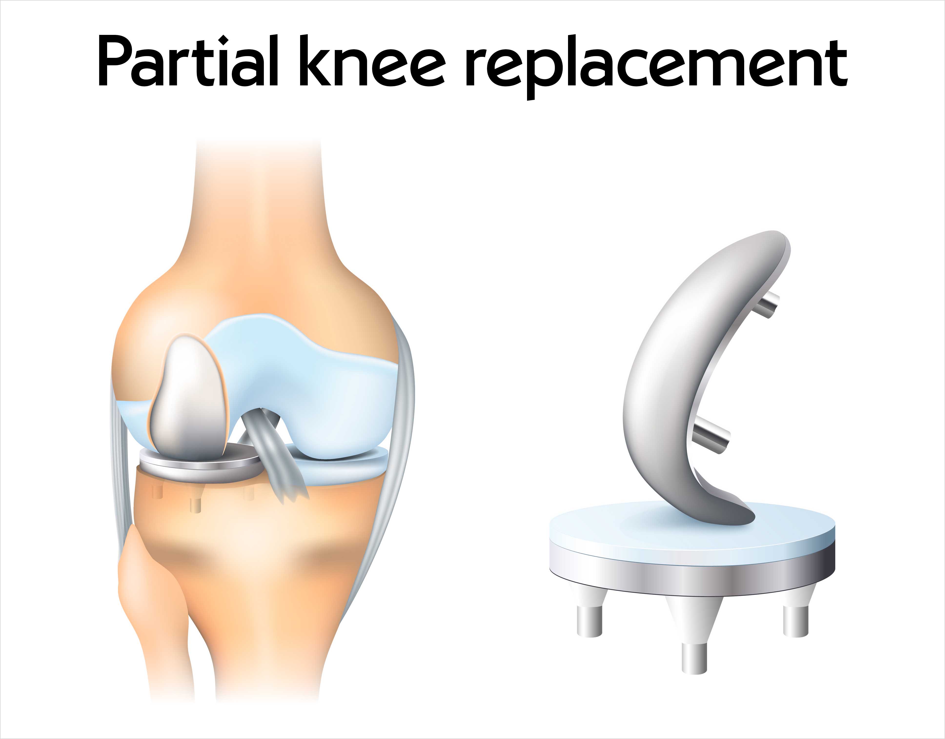 Partial knee replacement