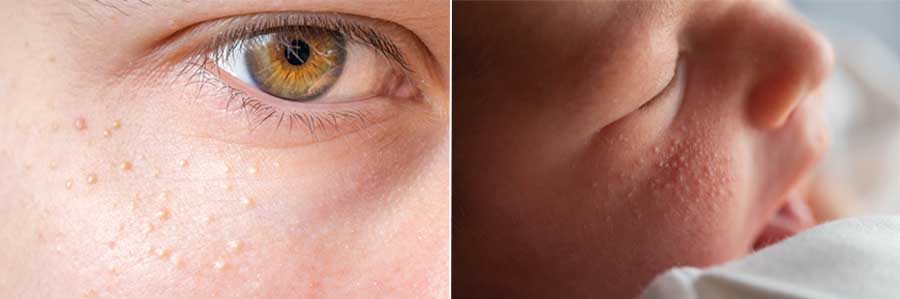 Two-panel image: top shows a cluster of small white-yellow bumps on an adult's cheek below the eye; bottom shows similar tiny white bumps on a baby's cheek and nose, typical of milia.