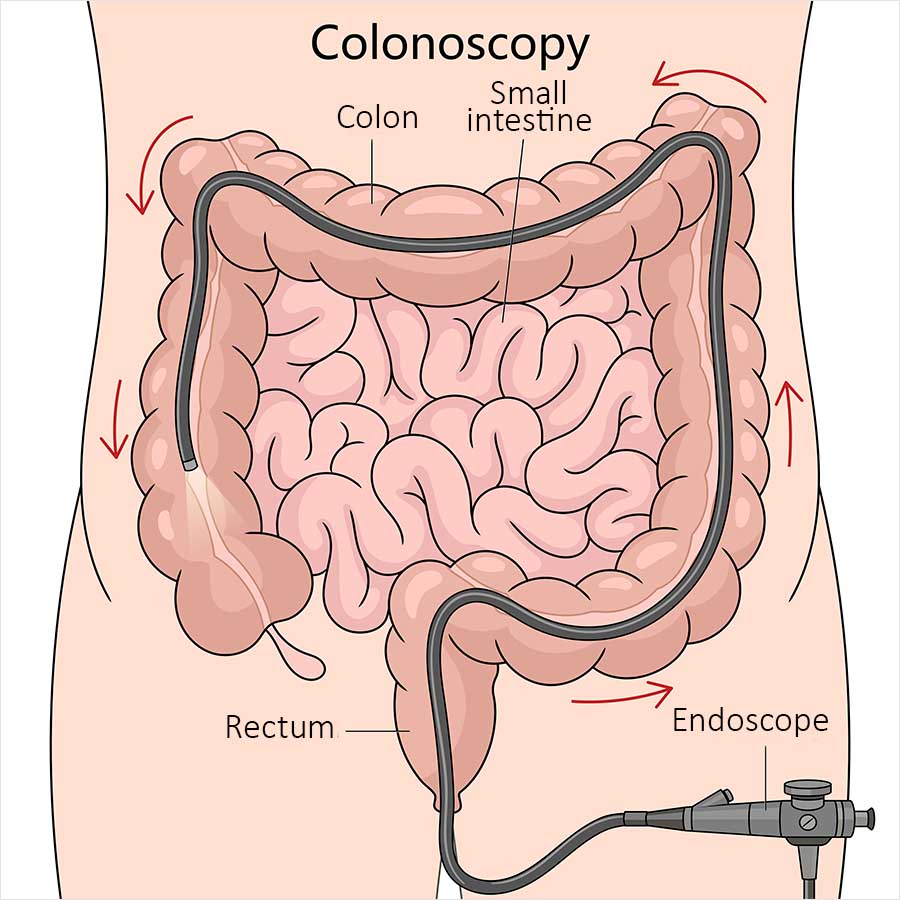 Illustration of the abdomen showing the large bowel. A flexible endoscope enters through the rectum and follows the colon upwards on the right side, across the top and down the left, with red arrows marking the direction of travel. Labels identify the colon, small intestine, rectum and endoscope.