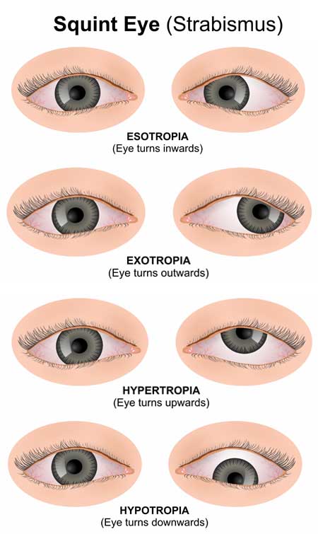 Illustrated medical infographic titled “Squint Eye (Strabismus)” showing four common types of eye misalignment. The image presents pairs of eyes demonstrating: Esotropia (eye turns inward), Exotropia (eye turns outward), Hypertropia (eye turns upward), and Hypotropia (eye turns downward). Each condition is labeled with its name and a brief description, with the misaligned eye position clearly illustrated for comparison. Gray background with realistic drawings of eyes and eyelids.