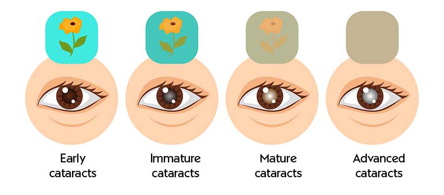 Illustration of eyes showing the four stages of cataracts - early cataracts, immature cataracts, mature cataracts and advanced cataracts
