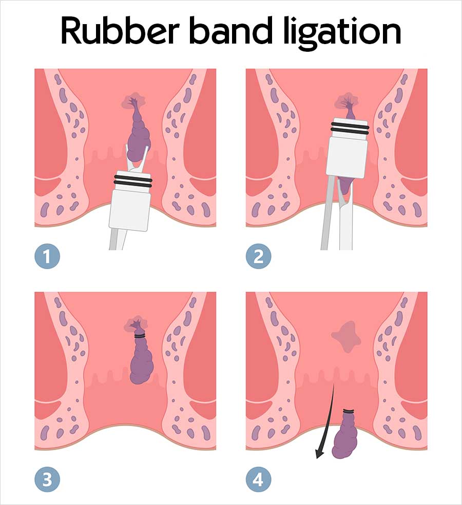 Four-panel illustration titled "Rubber band ligation" showing the stages of banding an internal haemorrhoid inside the anal canal.