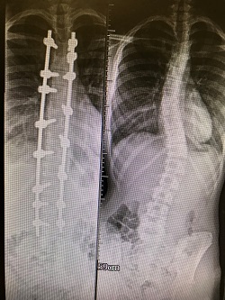 Scoliosis xray before and after surgery