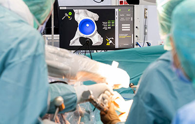 Surgeons in an operating theatre performing a robotic-assisted hip replacement, with the robotic arm in the foreground and a monitor displaying a 3D image of the hip joint.