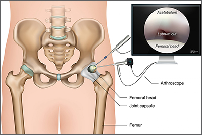 Medical illustration demonstrating a hip arthroscopy procedure on the right hip (viewer's left). Labels on the main illustration identify the femur, femoral head, and joint capsule. An arthroscope, with labels pointing to its scope and light source, is shown inserted into the joint capsule, and a second instrument is also visible within the joint space. A monitor in the top right corner displays the camera view from the arthroscope, with labels indicating the acetabulum, labrum, and a labrum cut, as well as the femoral head.