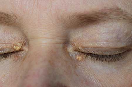 Close up of woman eyes with Xanthelasma on the eyelids.