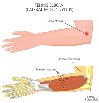 Diagram of tennis elbow and inflammed tendons