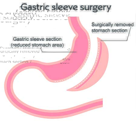 Diagram of gastric sleeve surgery showing the stomach reduced to a narrow sleeve, with the surgically removed section of the stomach shown separately alongside it.