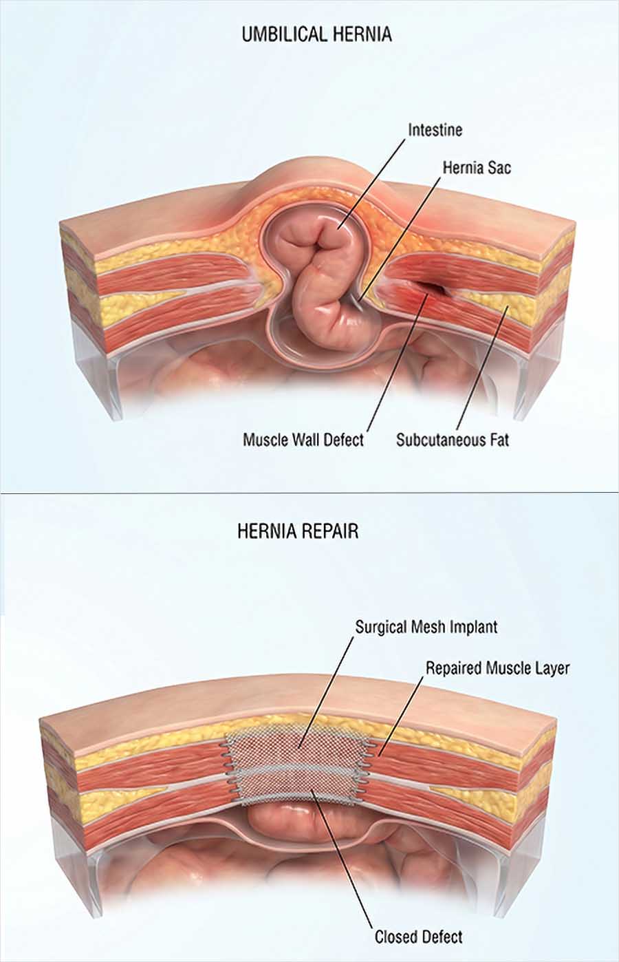Cross-section illustration comparing an umbilical hernia, where intestine pushes through a gap in the abdominal muscle, with the same area after repair with surgical mesh.