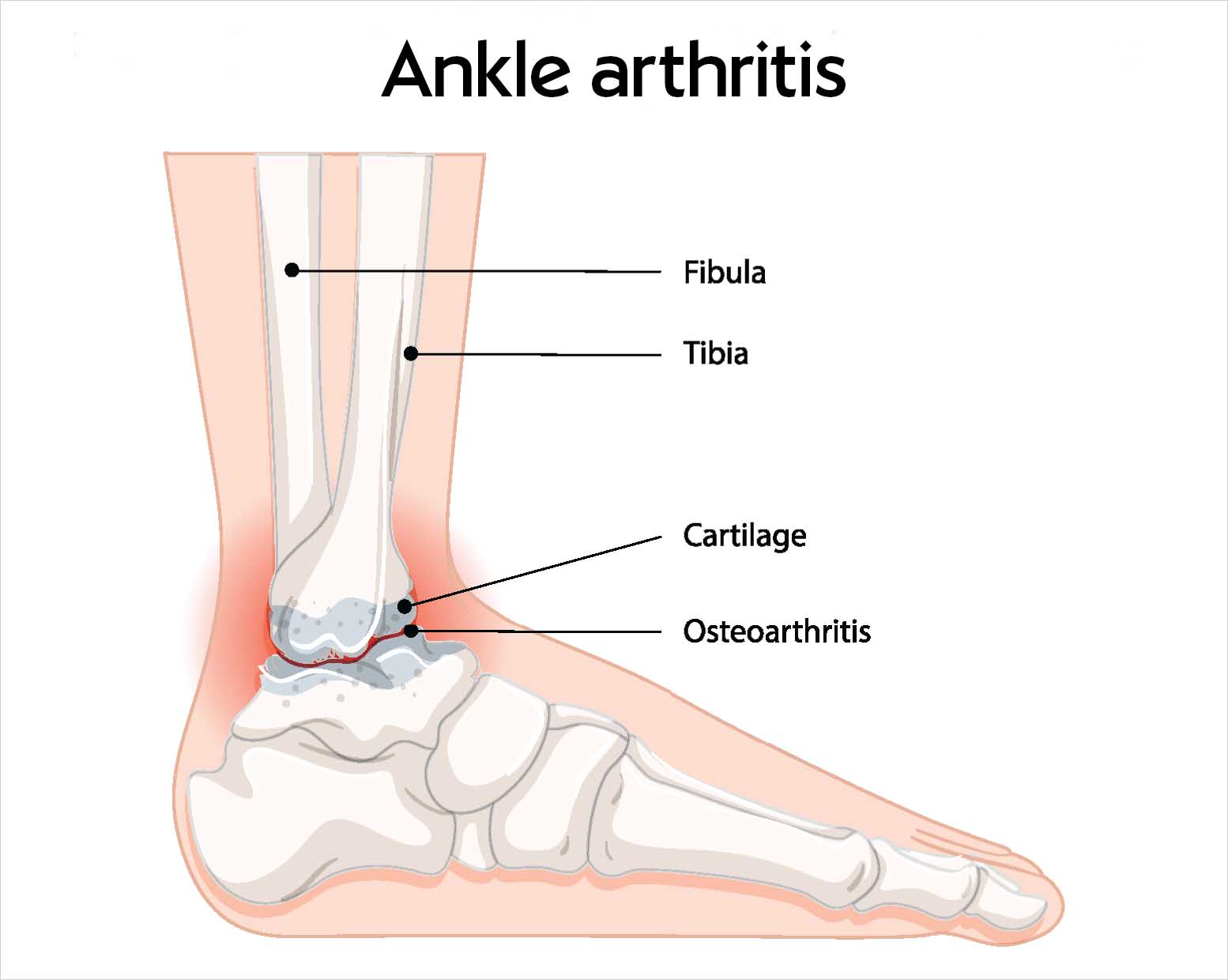 Diagram titled "Ankle arthritis" showing a side view of the foot, with labels for the fibula, tibia, cartilage and osteoarthritis at the worn ankle joint, which is highlighted in red.