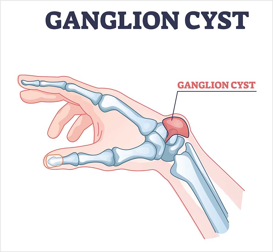 Side-on illustration of a hand and wrist showing the bones, with a ganglion cyst highlighted in red as a rounded lump on the back of the wrist.