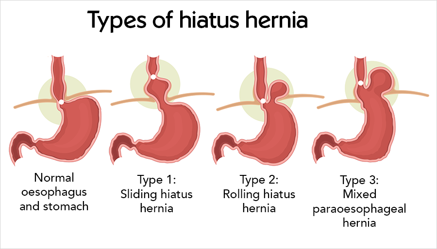 Diagram comparing normal anatomy with three types of hiatus hernia: type 1 sliding, where the stomach and oesophageal junction slide up through the diaphragm; type 2 rolling, where part of the stomach bulges up beside the oesophagus; and type 3 mixed, which combines both.