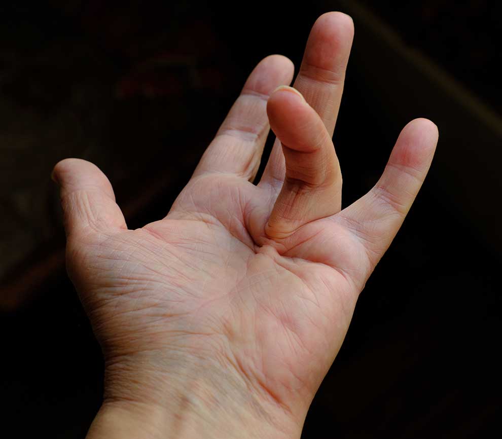 Photograph of an open palm, facing up, with one finger bent in towards the palm and unable to straighten, as seen in Dupuytren’s contracture.