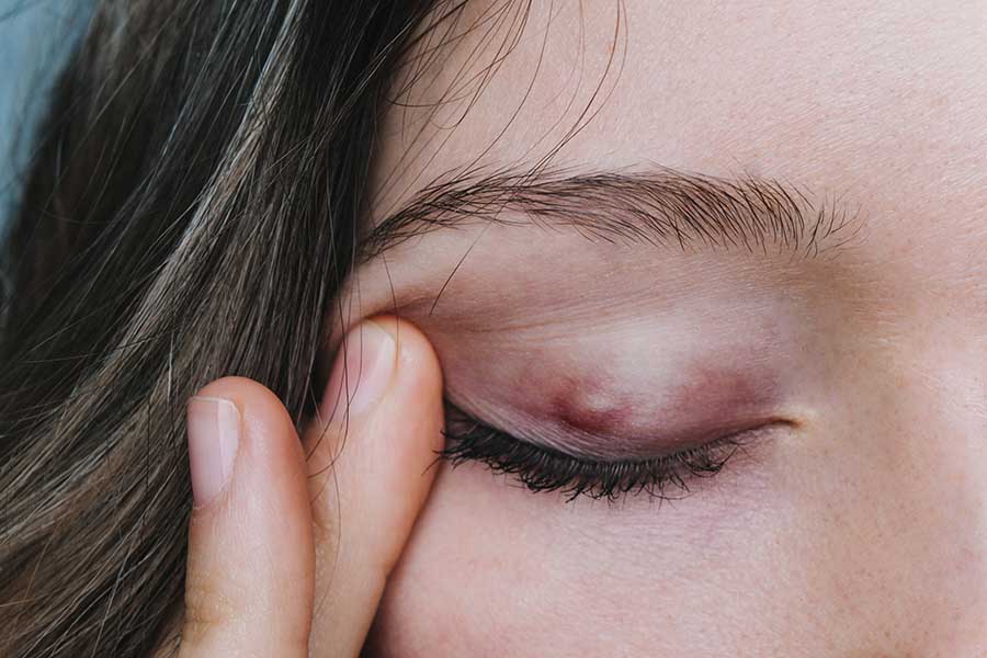 Red, swollen lump on the upper eyelid, characteristic of a chalazion.