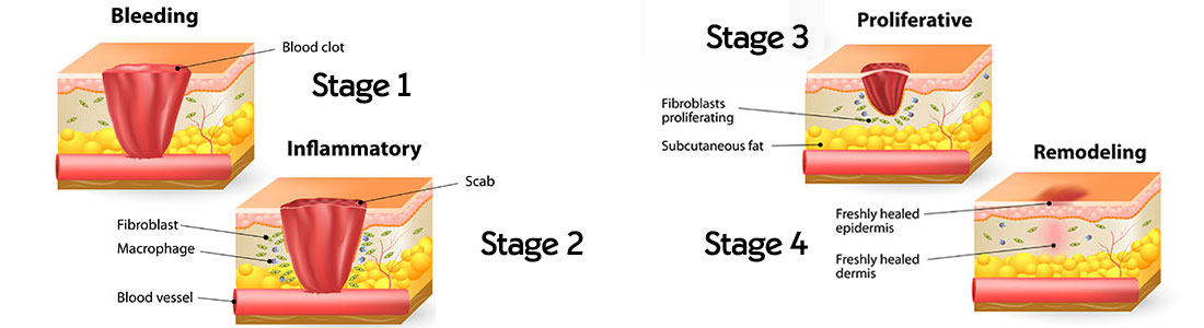 Stages of wound healing