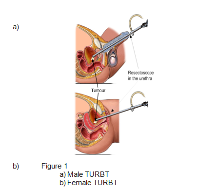 Transurethral resection of bladder tumour (TURBT) on male and female