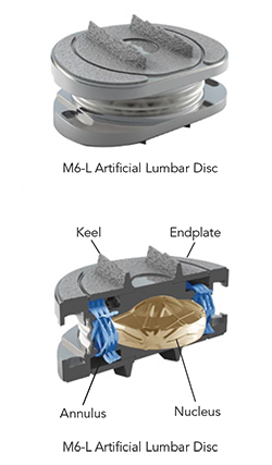 M6-L Artificial Lumbar Disc © 2009 Spinal Kinetics.jpg