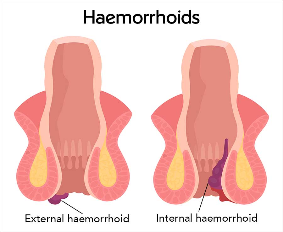 Medical illustration titled "Haemorrhoids" showing two cross-sections of the anal canal side by side. The left diagram labels an external haemorrhoid, a small purple swelling below the anal opening. The right diagram labels an internal haemorrhoid, a purple swollen vein inside the anal canal above the anal opening.