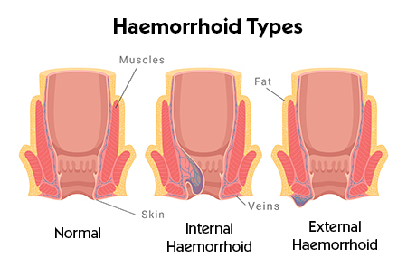 Medical illustration showing internal and external hemorrhoids. 