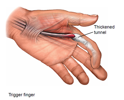 Medical illustration to explain Trigger finger