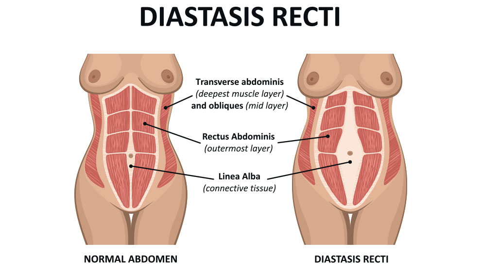 Diastasis recti