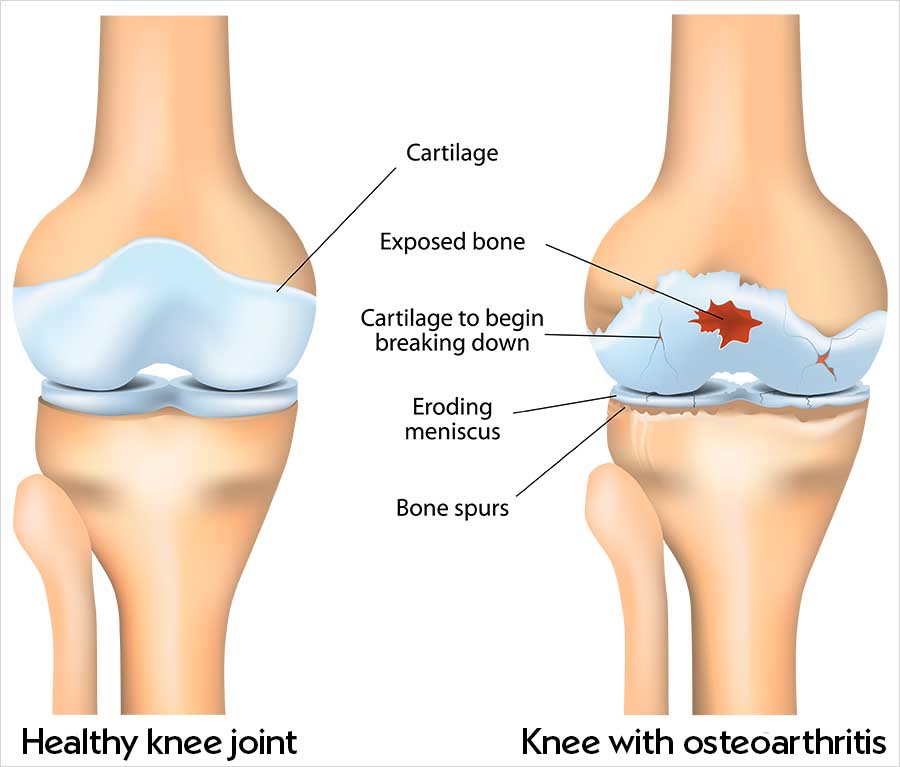 Illustration comparing a healthy knee joint, with smooth cartilage covering the bone ends, and a knee with osteoarthritis, where the cartilage is cracked and worn away to expose bone.