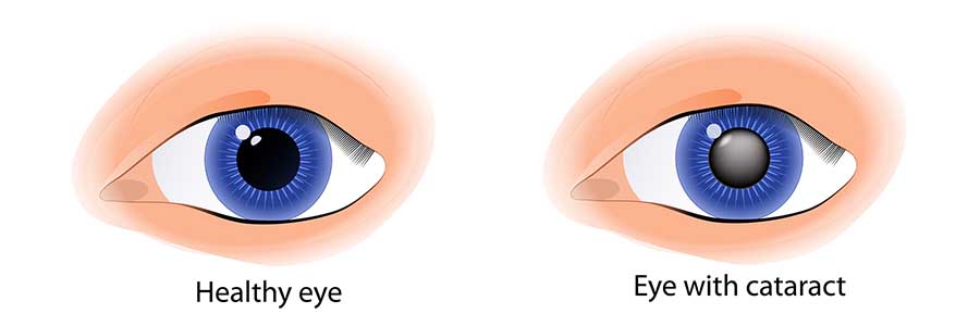 Illustration of a healthy eye and an eye with cataracts