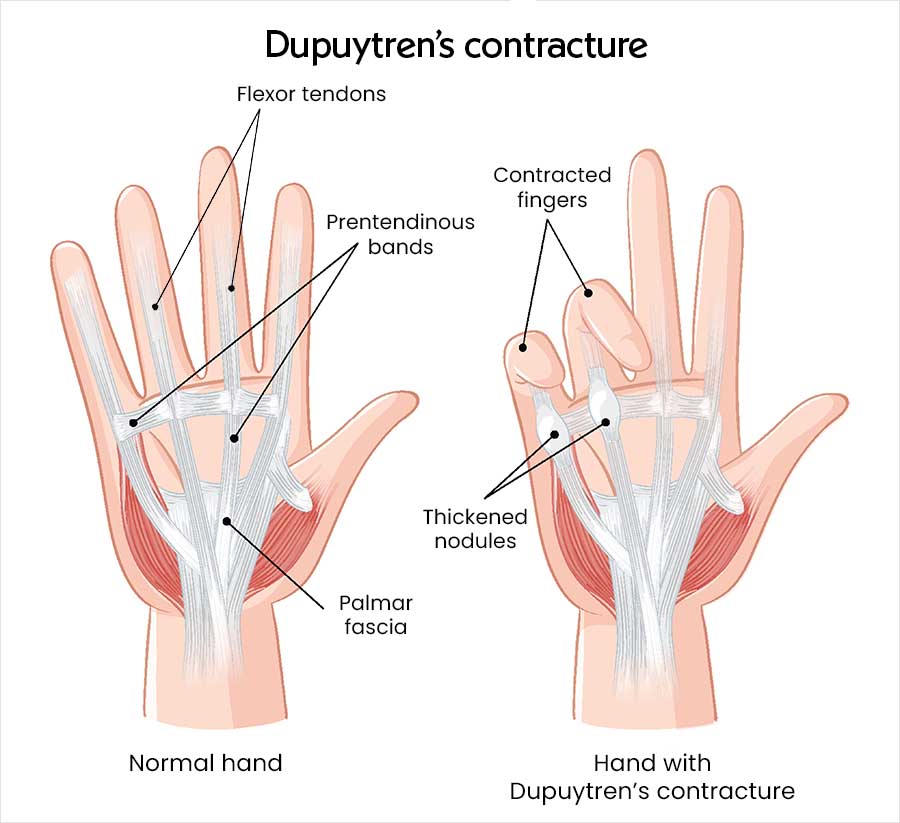 Two illustrations of the palm side of a hand, labelled “Dupuytren’s contracture”. The normal hand on the left shows the flexor tendons, prependinous bands and palmar fascia. The hand with Dupuytren’s contracture on the right shows thickened nodules in the palm and two fingers pulled in towards it.