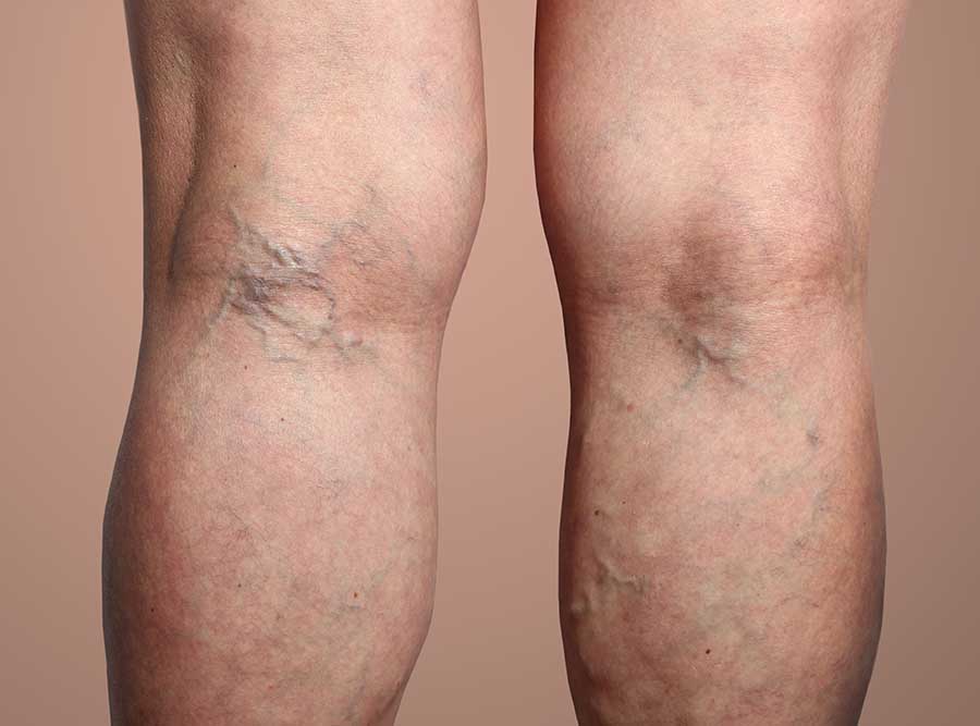 Varicose veins on the back of the leg