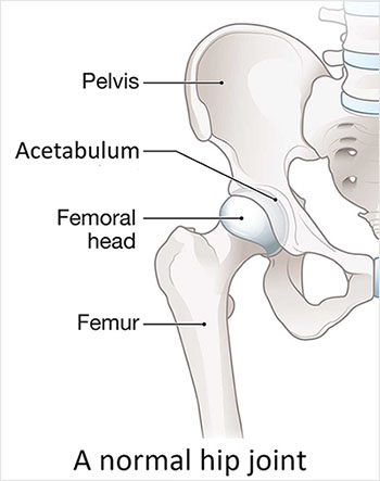 Medical illustration of a normal right hip joint, labelled to show the pelvis, the acetabulum (hip socket), the femoral head (ball at the top of the thigh bone), and the femur (thigh bone), with smooth joint surfaces where the ball sits in the socket.
