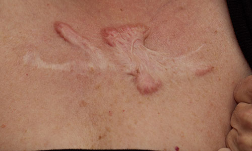 Keloid scar on chest