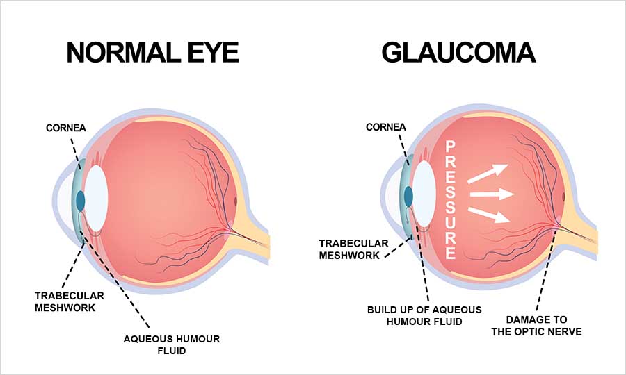 Labelled diagram comparing a cross-section of a normal eye with a glaucomatous eye, showing a build-up of aqueous humour fluid at the trabecular meshwork, raised pressure inside the eye and damage to the optic nerve.
