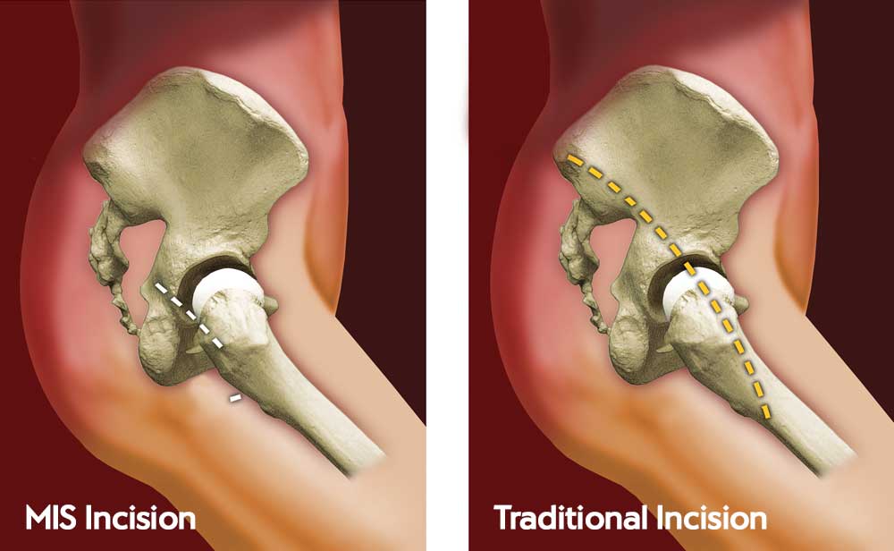 Minimally invasive hip surgery 