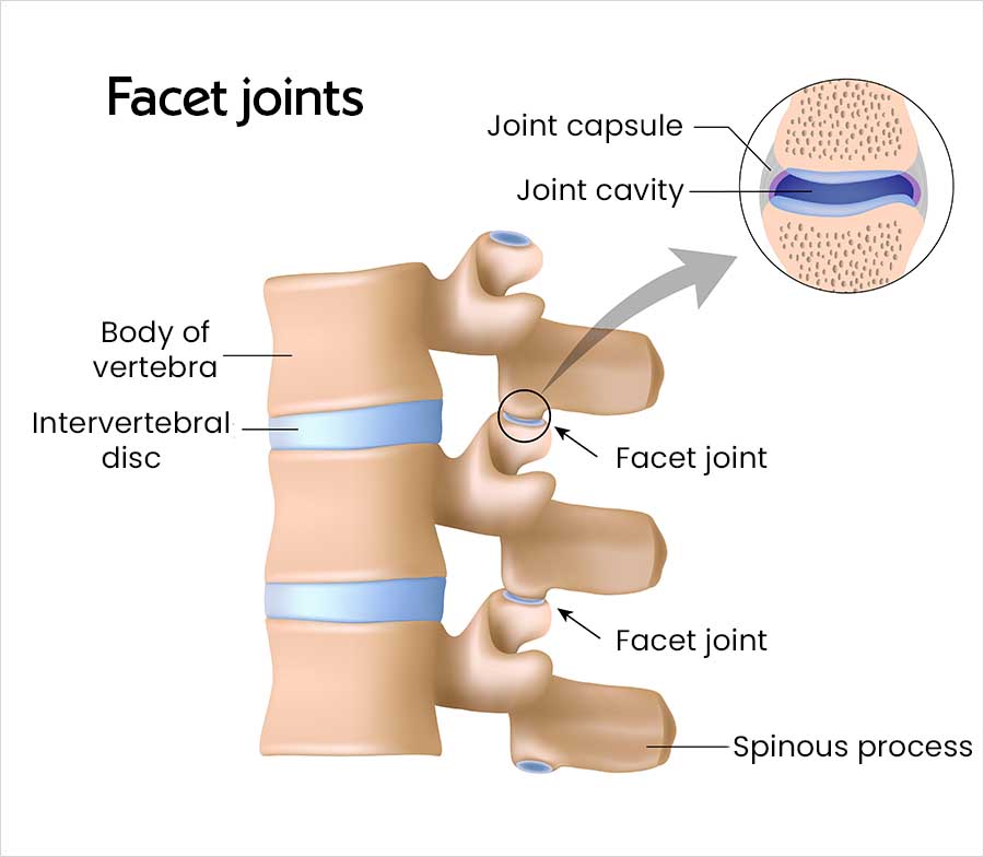 Diagram of three stacked spinal vertebrae viewed from the side, with labels for the vertebral body, intervertebral disc, spinous process and two facet joints. An enlarged inset shows the joint capsule surrounding the joint cavity.