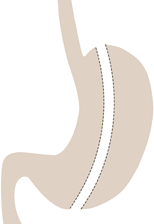 Sleeve Gastrectomy