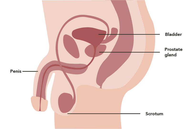 Aggressive cancer of the prostate Cruce helminthes