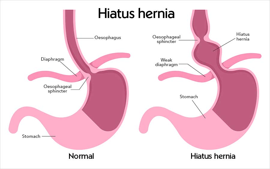 Diagram comparing a normal stomach and a hiatus hernia. On the left, the oesophagus passes through the opening in the diaphragm and meets the stomach below it, with the oesophageal sphincter at the junction. On the right, the diaphragm opening is weakened and the top of the stomach has pushed up through it into the chest, so the oesophageal sphincter now sits above the diaphragm.