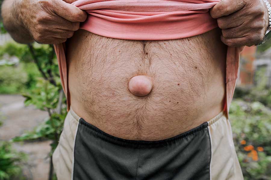 An adult elderly man shows a large umbilical hernia on his abdomen.