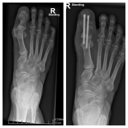 Debra's foot x-rays before and after surgery