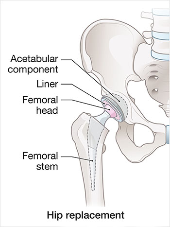Medical illustration of a right hip after total hip replacement, showing the artificial acetabular cup and liner in the pelvis, plus a metal femoral stem and rounded femoral head in the thigh bone.