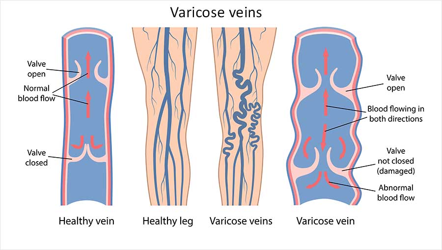 Diagram comparing a healthy vein with a varicose vein, showing how damaged valves allow blood to flow backwards in the leg.