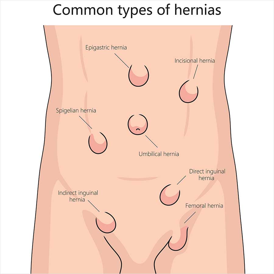 Illustration of a torso labelling the positions of seven common hernias: epigastric, incisional, Spigelian, umbilical, direct inguinal, indirect inguinal and femoral.