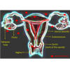 Image showing female reproductive organs and endometriosis.